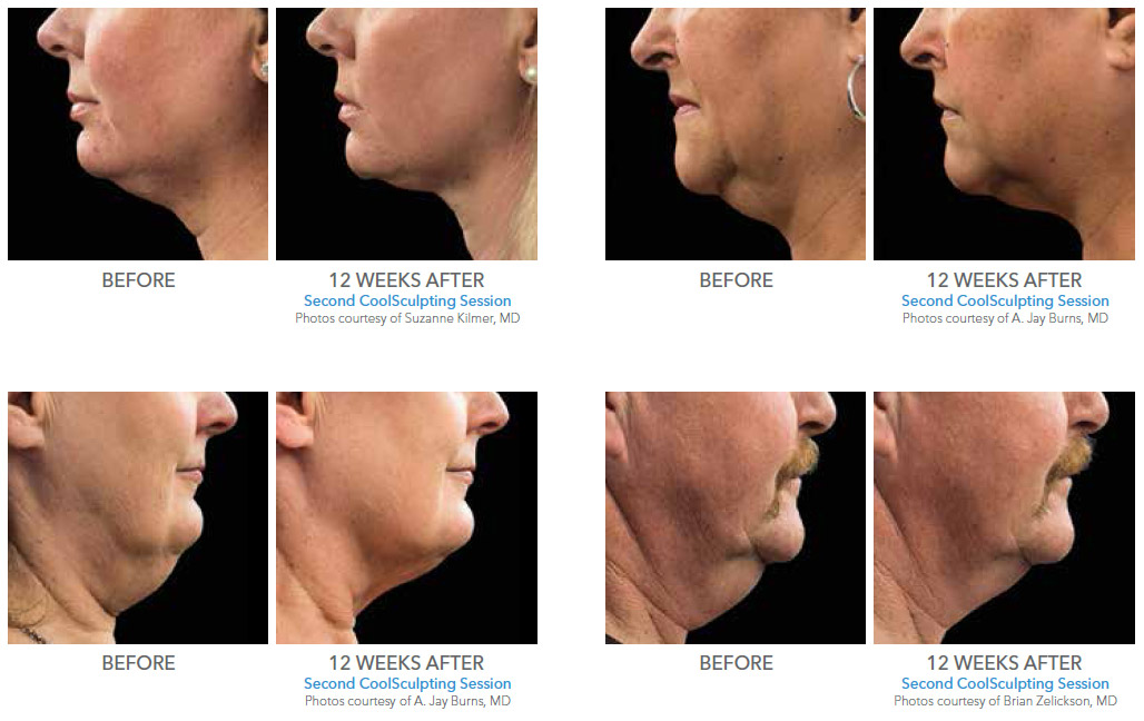Reduce Double Chin Fat With CoolSculpting